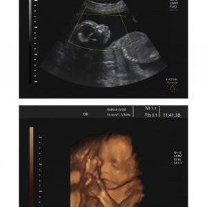 ultrasound